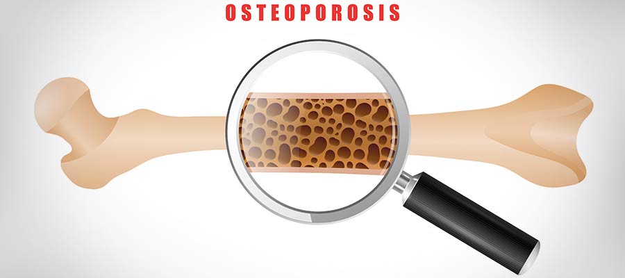 Osteoporosis: Symptoms, Causes and Treatment